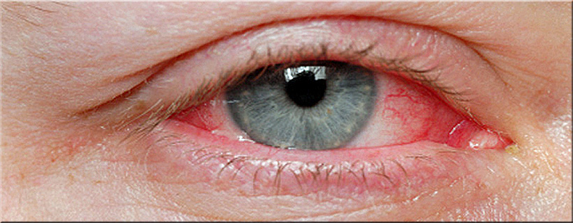 Guidance on safe contact lens wear, cleaning routines, and complication prevention