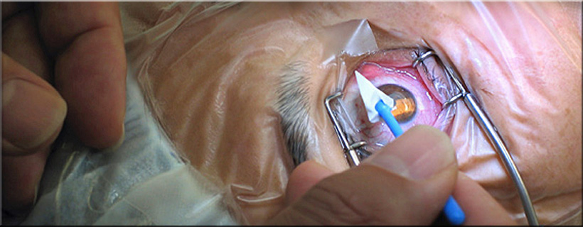 Pre-operative and post-operative care for LASIK and cataract surgery patients